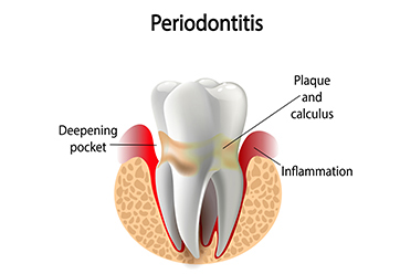 Periodontitis Treatment in San Diego