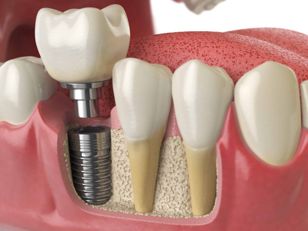 Dental Implants in San Diego