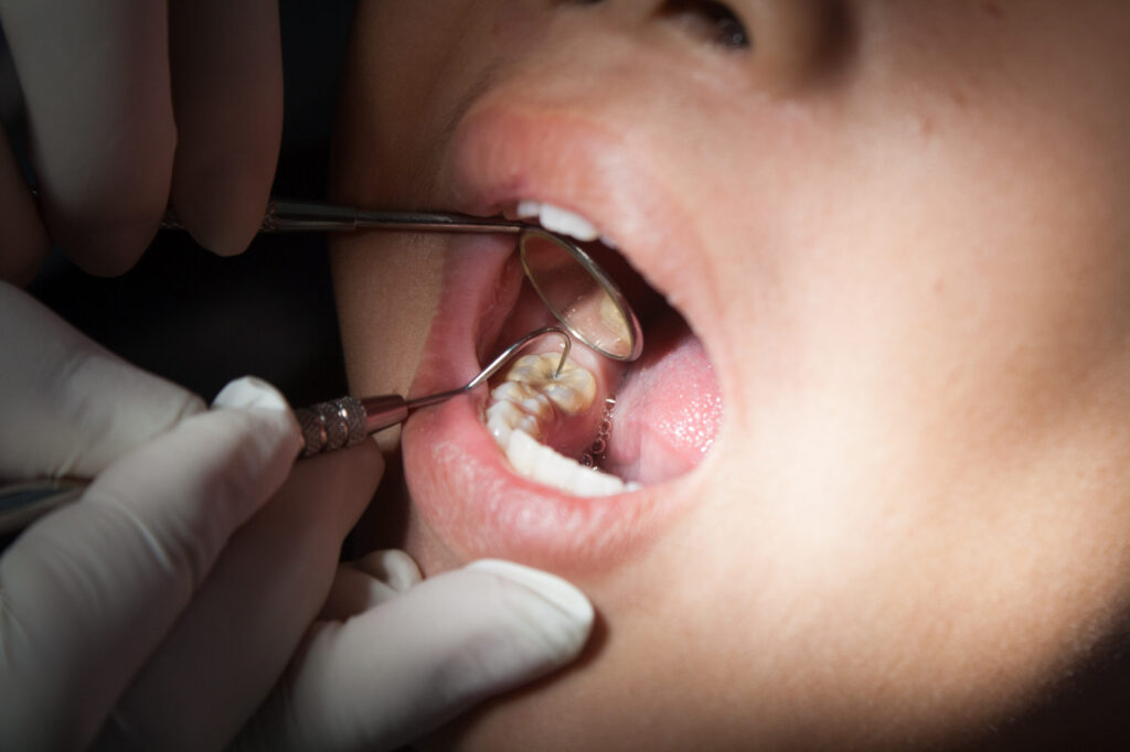 Are Dental Sealants a Suitable Option for Adults in Pacific Beach?