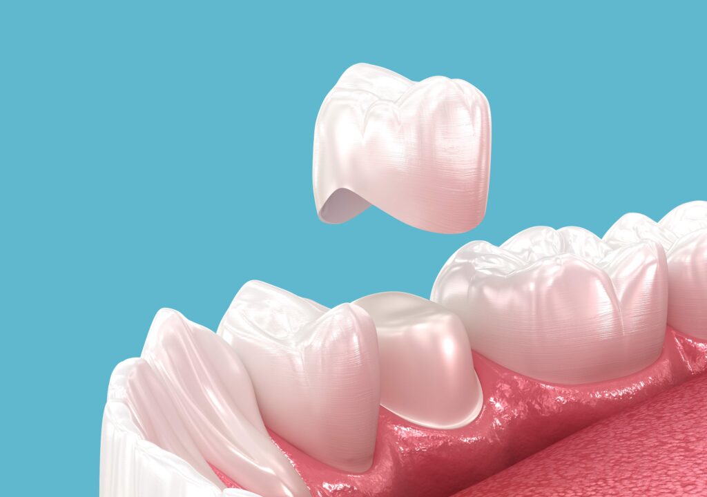 Dental Crowns Could Be the Solution to Restoring Your Smile