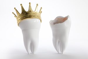 Dental Crowns in San Diego