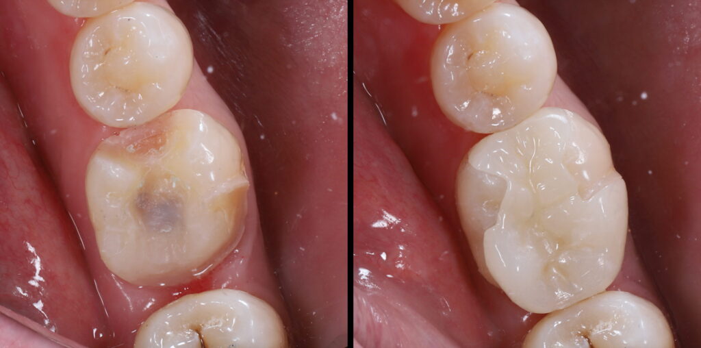 Dental Inlays and Onlays: Everything You Need to Know