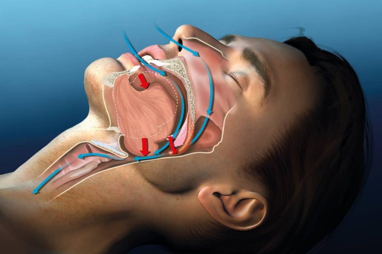 How Do Dental Lasers Treat Snoring?