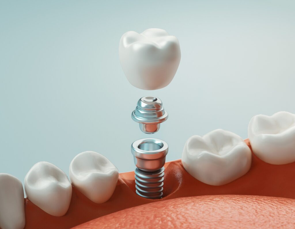What Are Dental Implants & How Do They Work?