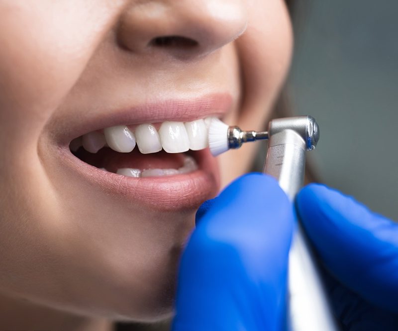 Dental hygienist polishing a patient’s teeth with a professional dental tool during a routine cleaning appointment – how long does a dentist clean take