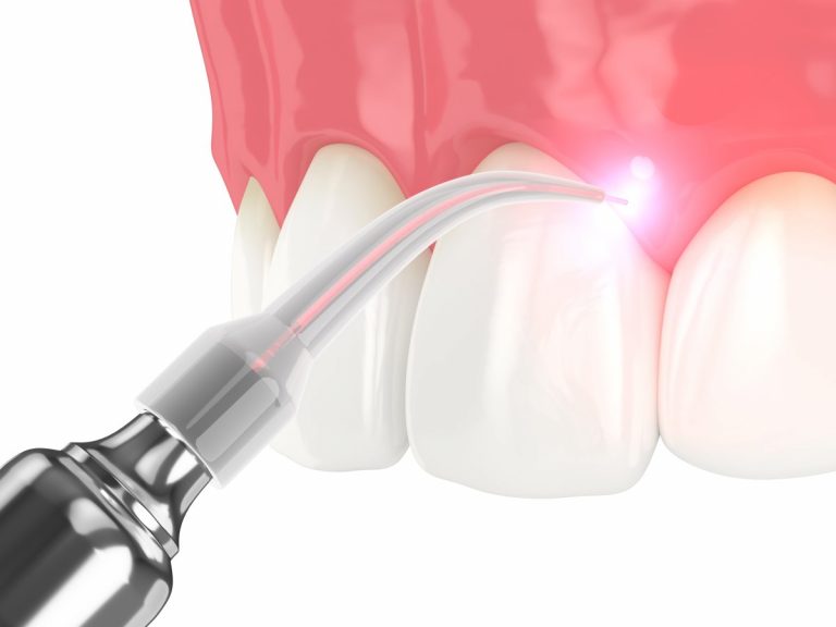 what is laser dentistry